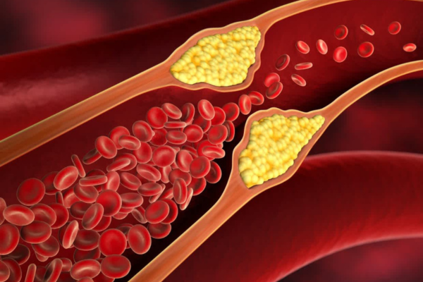 Illustration of an artery demonstrating a reduced flow of red blood cells due to a growth of cholesterol on the arterial walls.