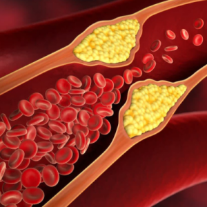 Illustration of an artery demonstrating a reduced flow of red blood cells due to a growth of cholesterol on the arterial walls.